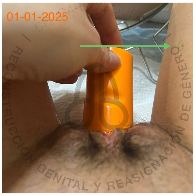 Resultado Vaginoplastia - Caso 3