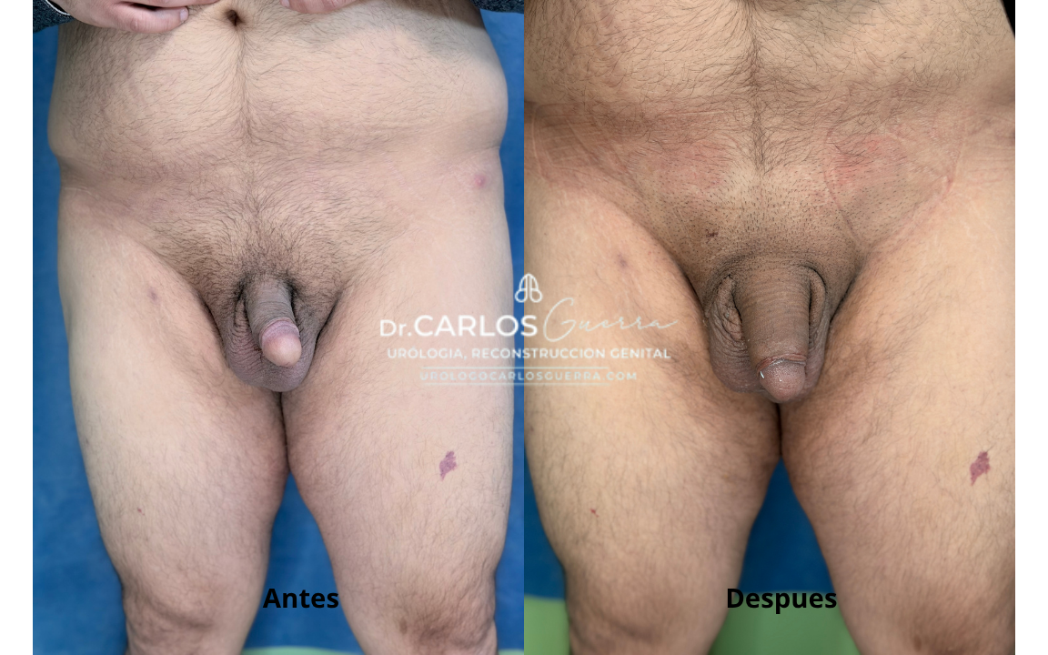 Finalmente, el resultado final de la cirugía