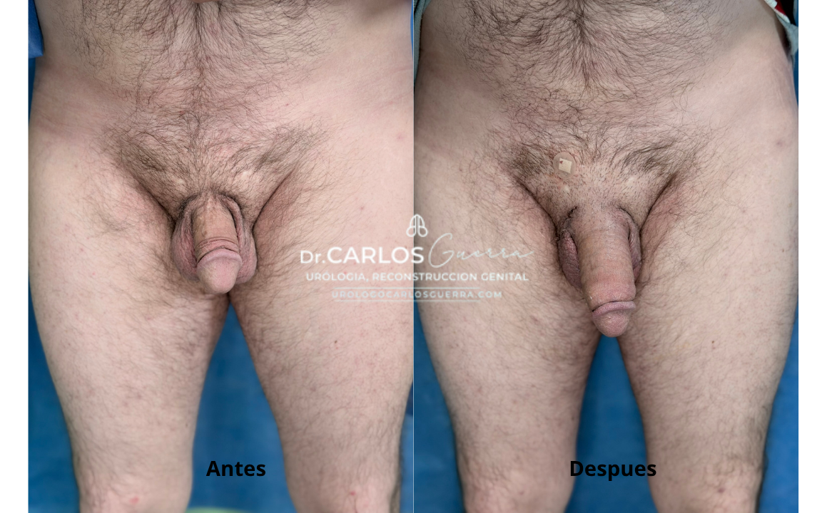 Consecuentemente, el perfil masculino mejorado