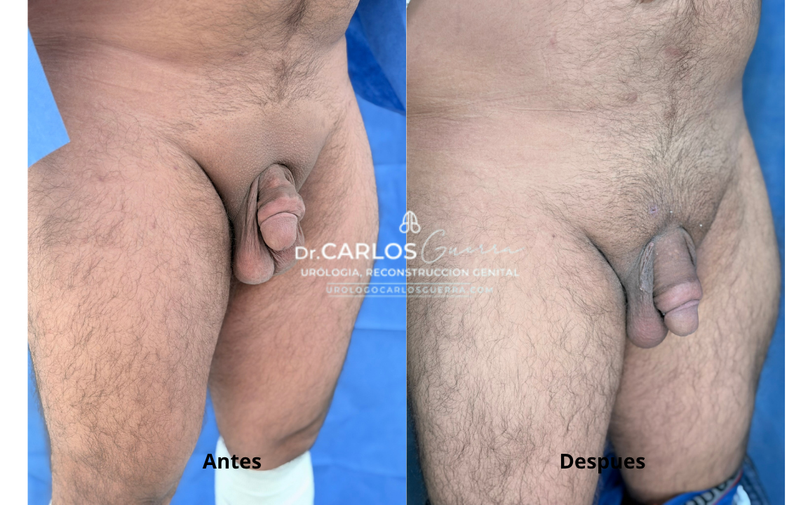 En este caso, la mejora volumétrica evidente