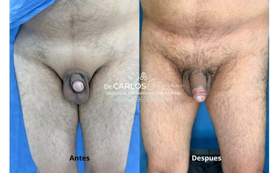 Primer caso exitoso del procedimiento Himplant